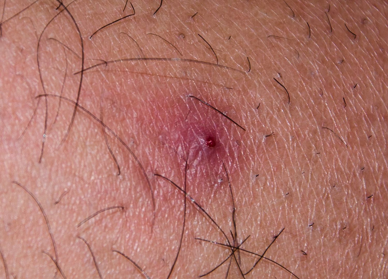 Boils: What they are and how to treat them