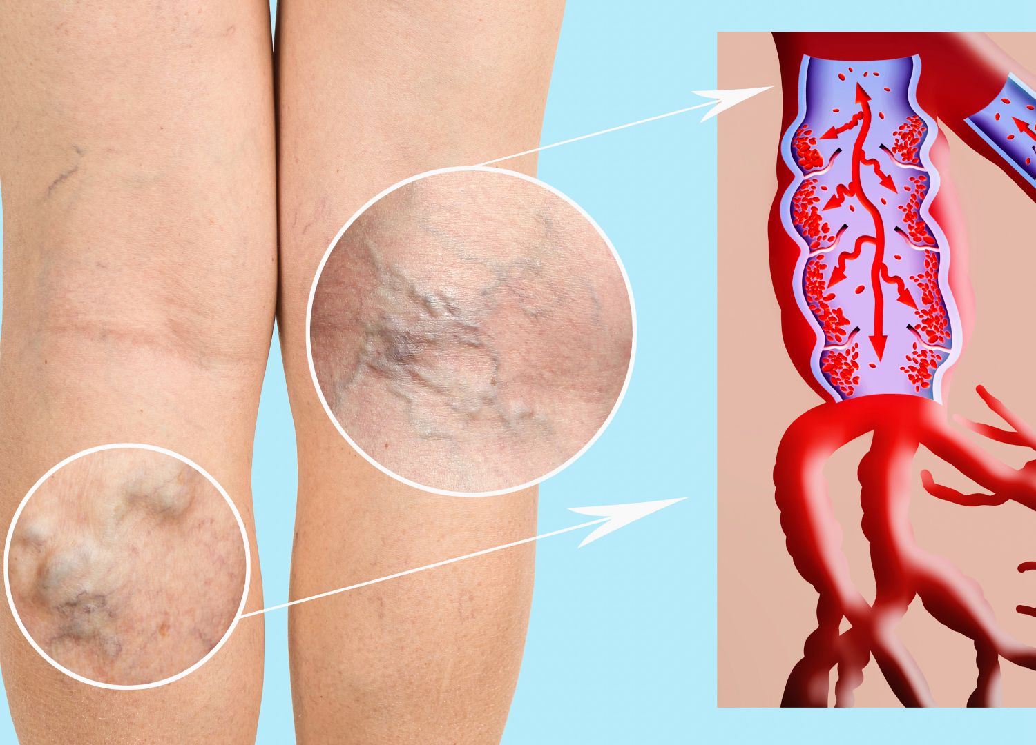 "Deep Vein Thrombosis: Dangerous blood clot  (Pidgin)"