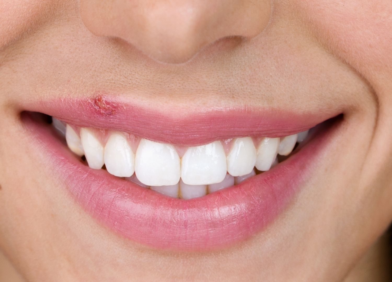 Cold Sores: Symptoms and Causes