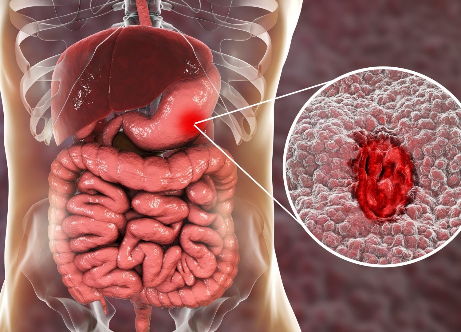 Irritable Bowel Syndrome and your mental health