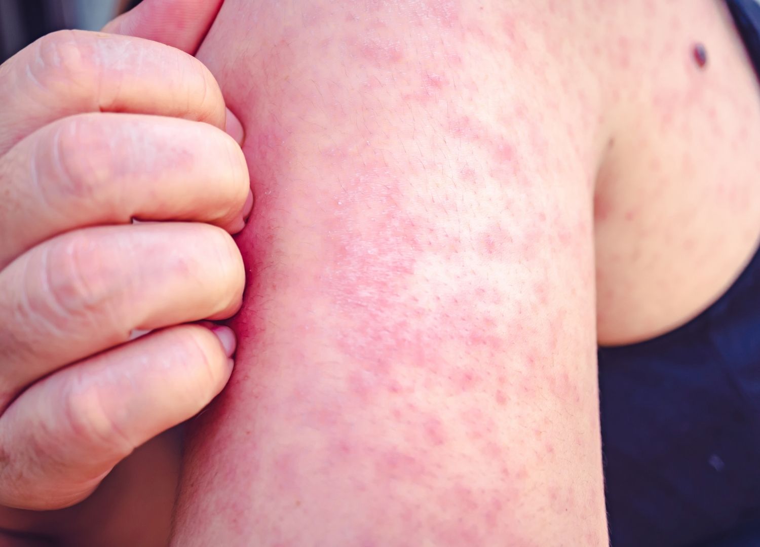 I get scabies?