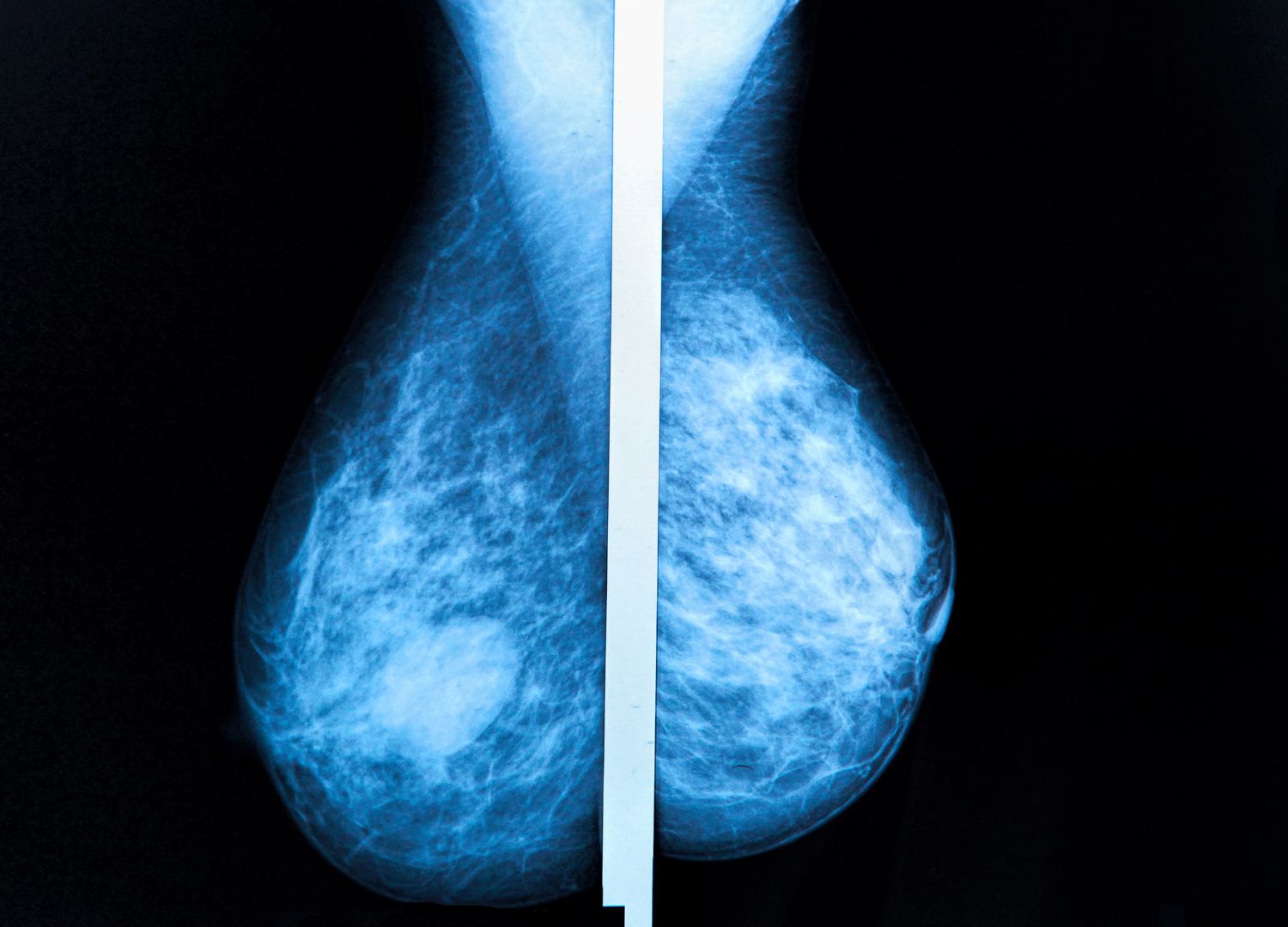 Breast Cancer in the young 05-10-2022 (2)
