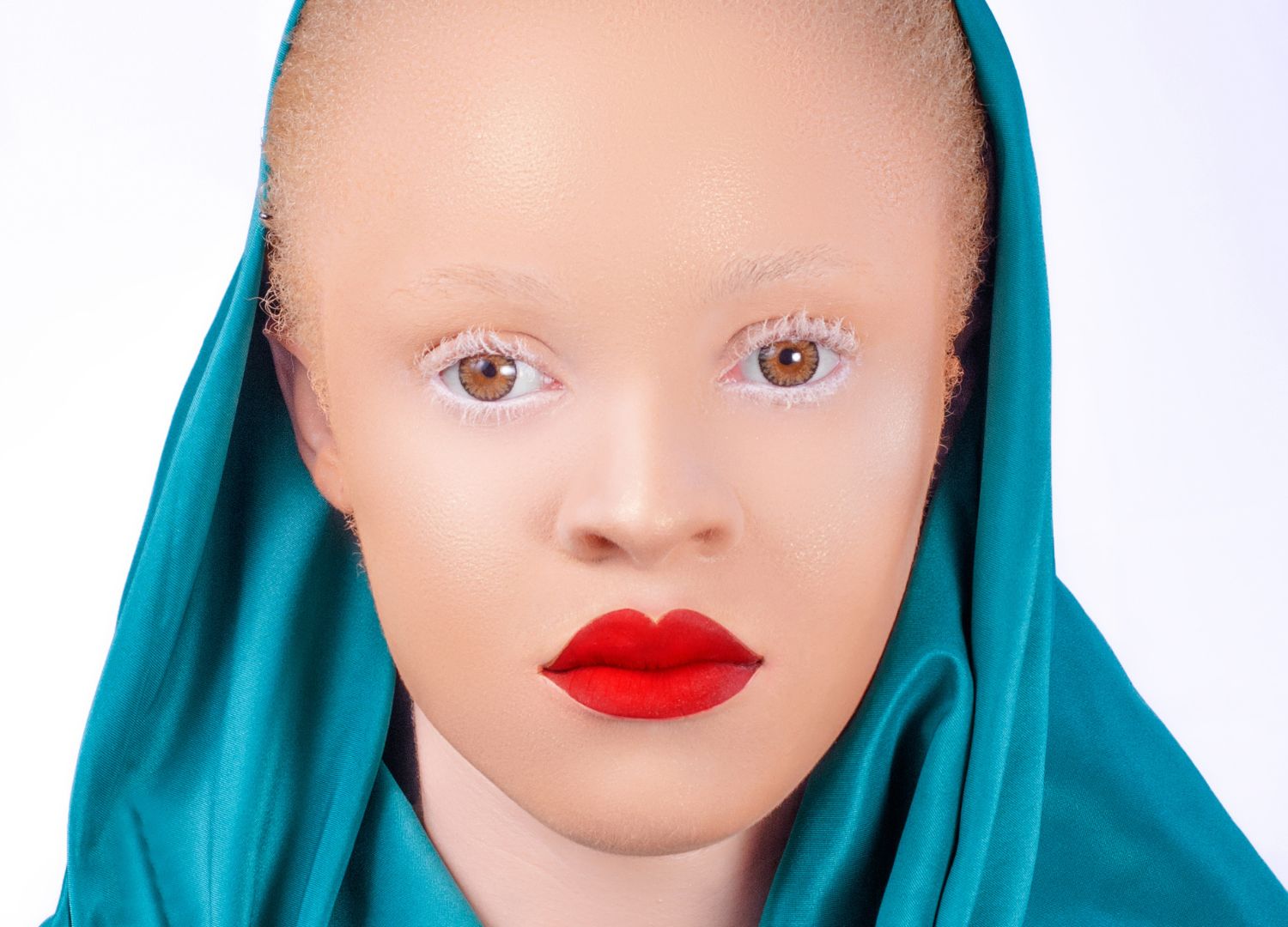Celebrating Albinism