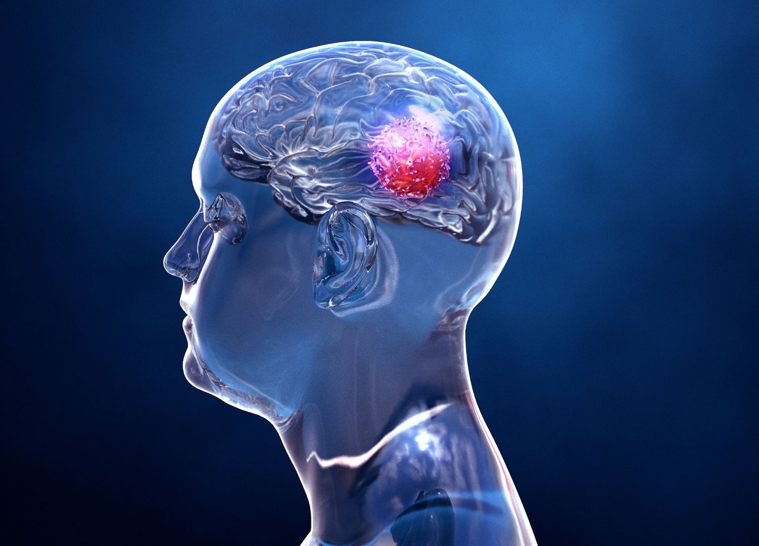 Craniopharyngioma: What is it and can it be prevented?