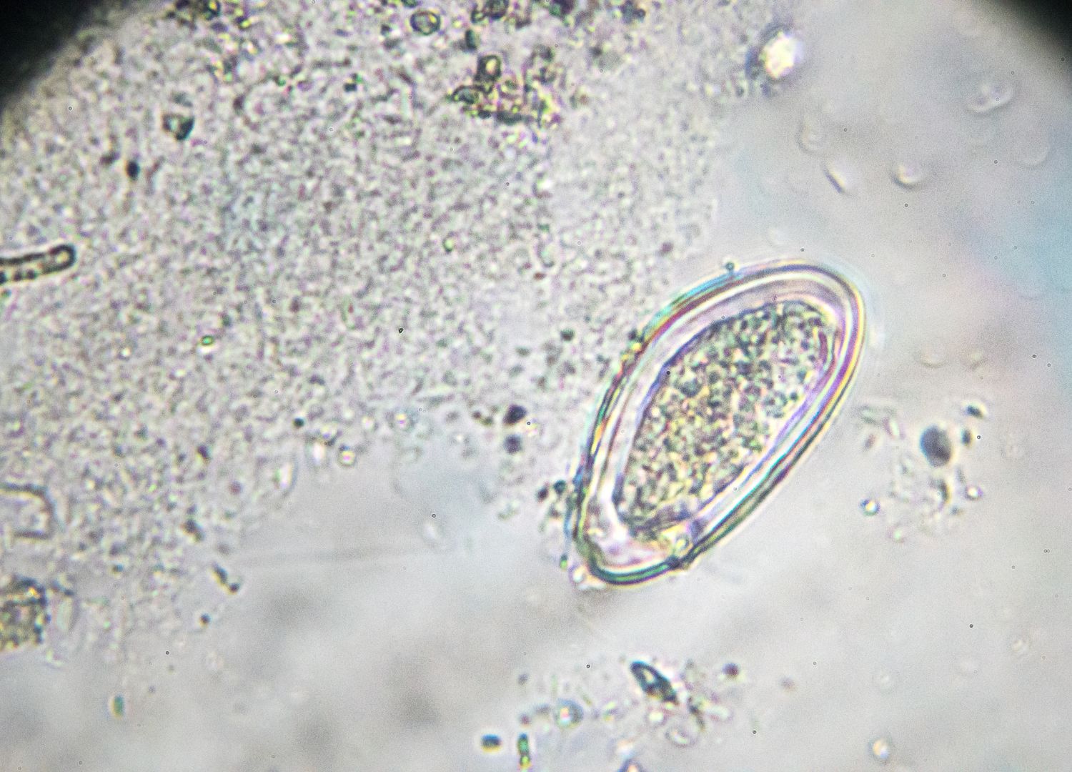 Pinworm Infections: Causes, Symptoms, and Effective Treatments