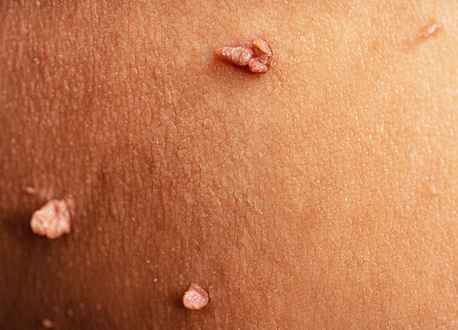 Skin changes not to ignore 28-03-2023 (2)